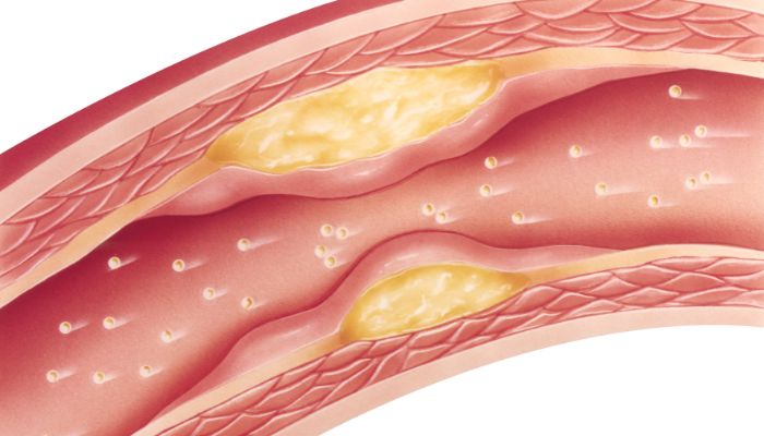 A dislipidemia